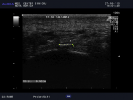 Ultrazvok pete - trn v peti (spina calcanea) boleča peta
